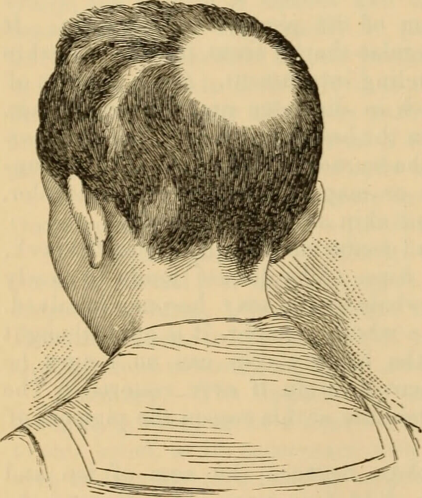 alopecia areata symptoms