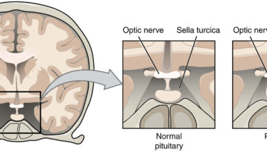 Pituitary tumour