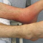 Cellulitis Risk Factors [Causes, and Treatment]