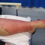 Cellulitis Risk Factors [Causes, and Treatment]