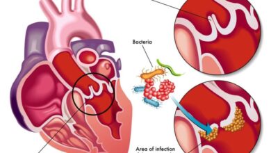 Infective Endocarditis