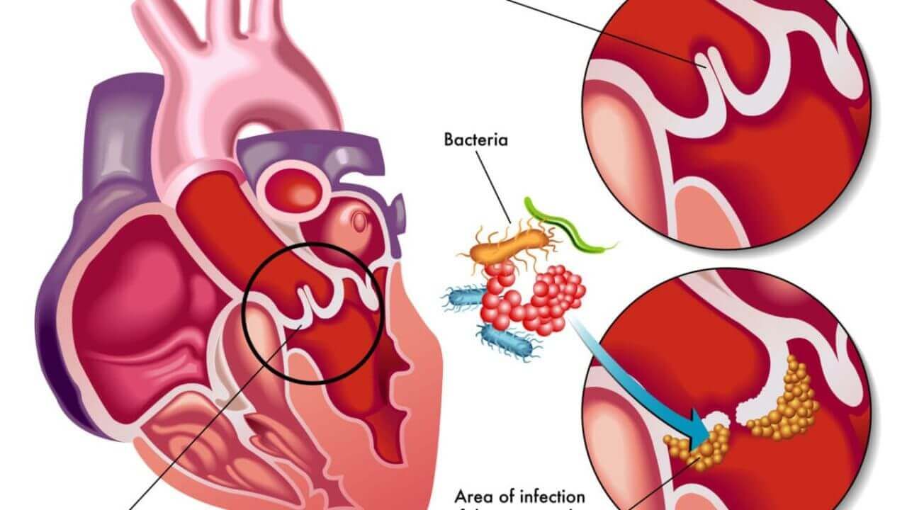 Infective Endocarditis