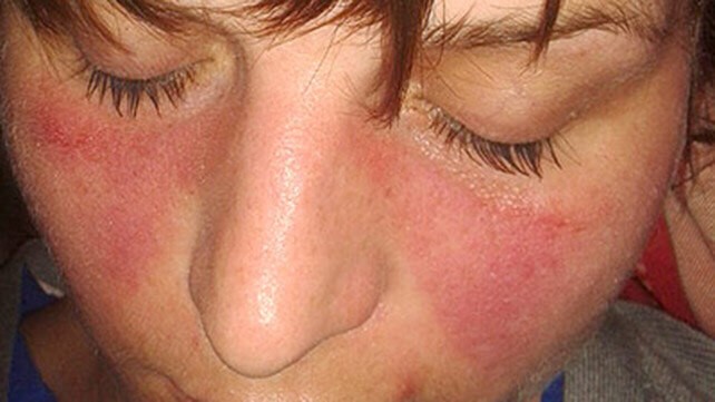 systemic lupus erythematosus