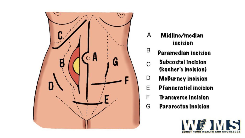 abdominal incisions