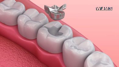 Amalgam Fillings