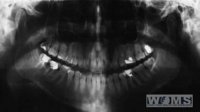 Baby teeth X-ray