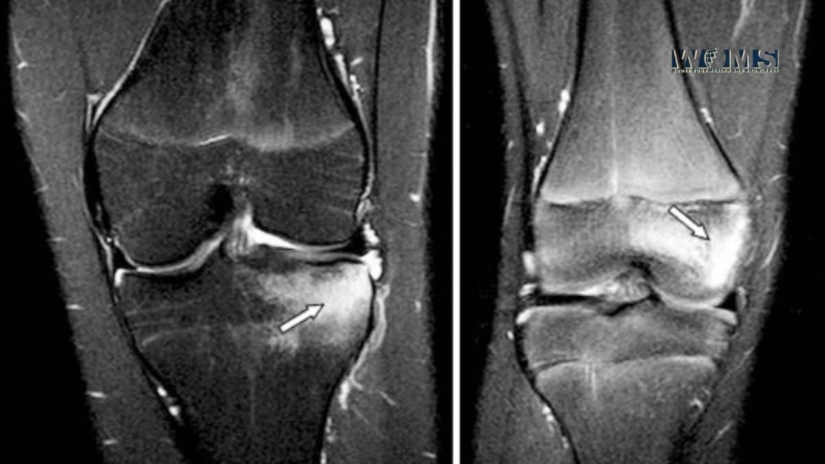 Bone Marrow Edema