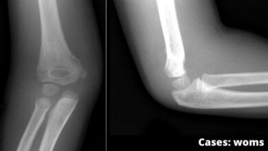 supracondylar fracture of humerus