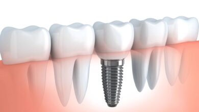 Contemplating on Dental Implants