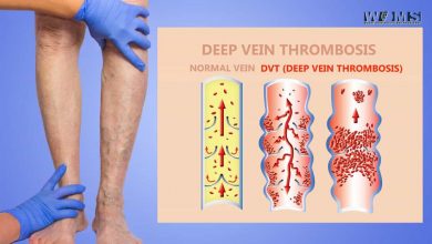 Deep Vein Thrombosis