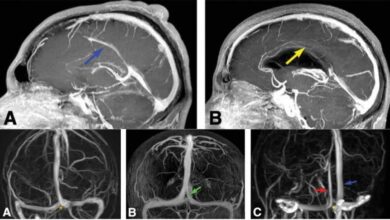 dural venous sinuses