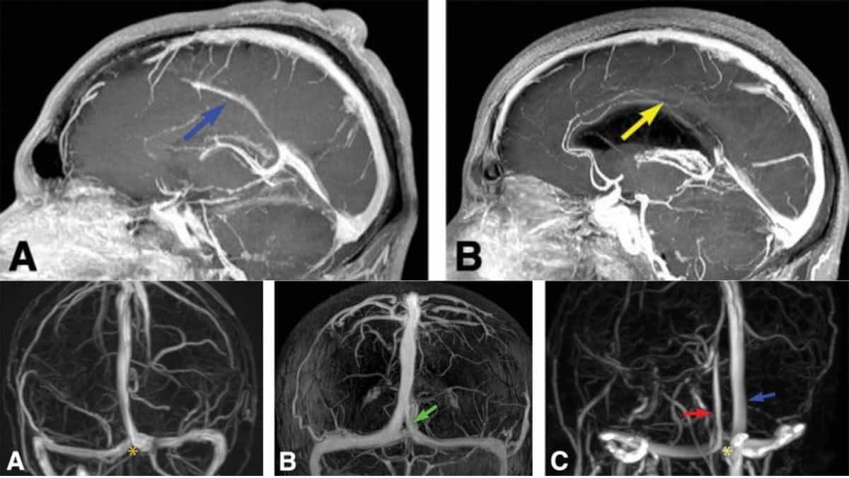 dural venous sinuses