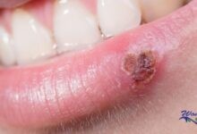 Essential oils for cold sores