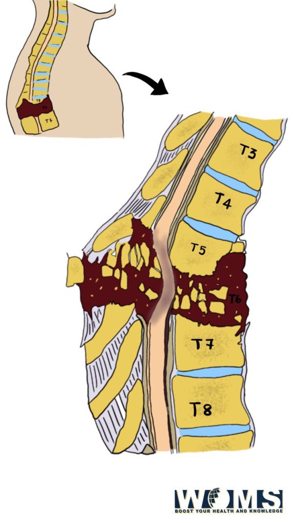 fractured vertebrae