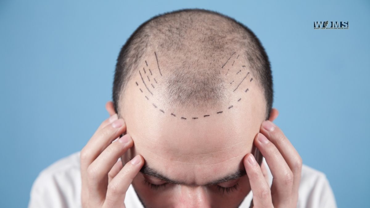 hair transplant cost