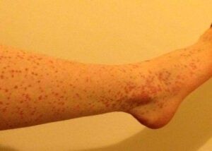 Idiopathic Thrombocytopenic Purpura (ITP)