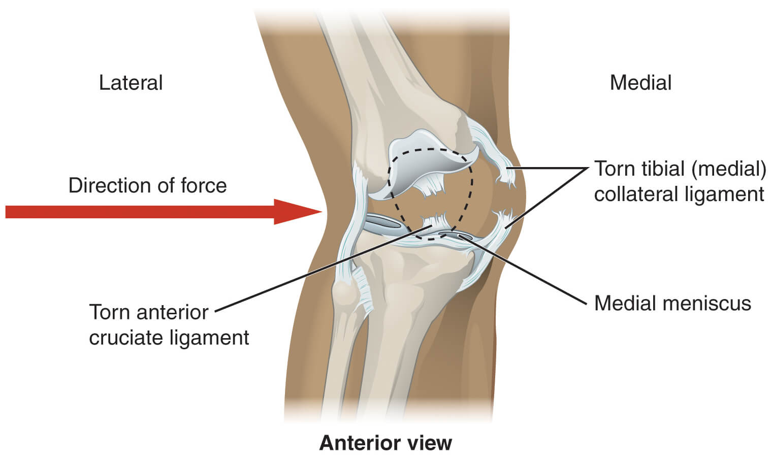 Natural Remedies for Joint Pain