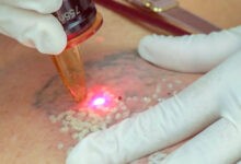 Tattoo Laser Removal