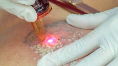 Tattoo Laser Removal