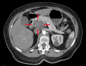 Adenocarcinoma of the pancreas