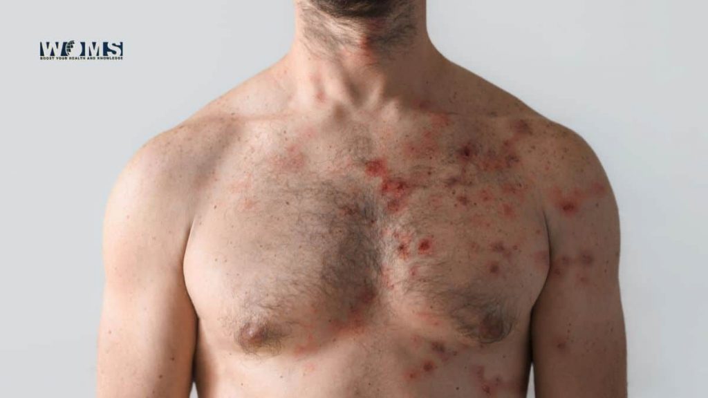 Monkeypox on Chest