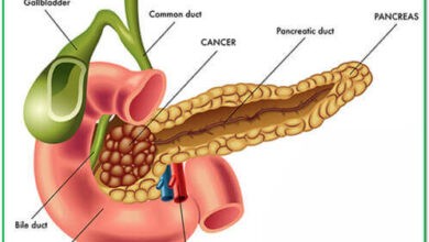 Adenocarcinoma of the pancreas