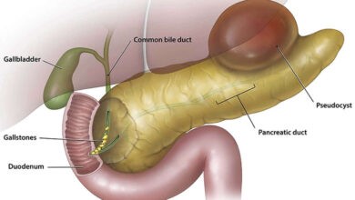 Pseudocyst of pancreas