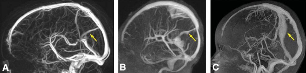 persistent falcine sinus