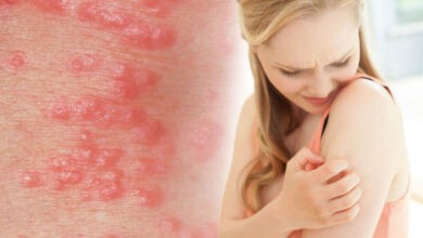 scabies signs and symptoms