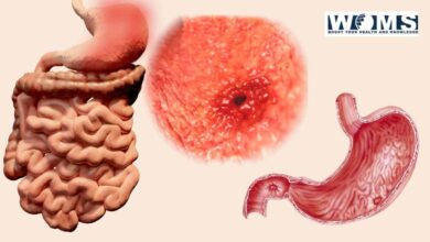 Signs of stomach ulcer