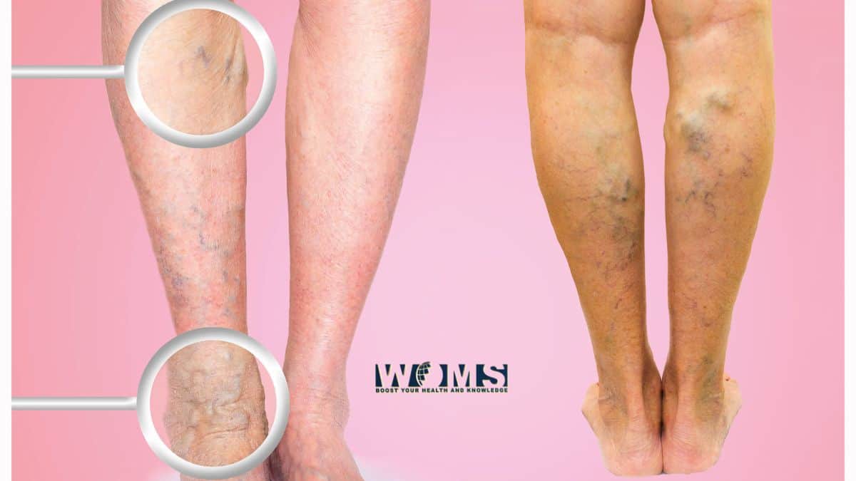 Varicose Veins