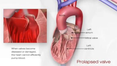 mitral valve disease