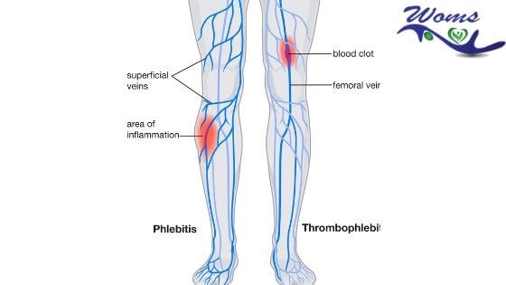 phlebitis and thrombophlebitis