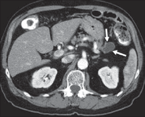 Pseudocyst of pancreas