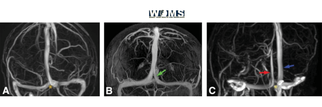 dural venous sinus