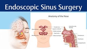 Sinus Surgery