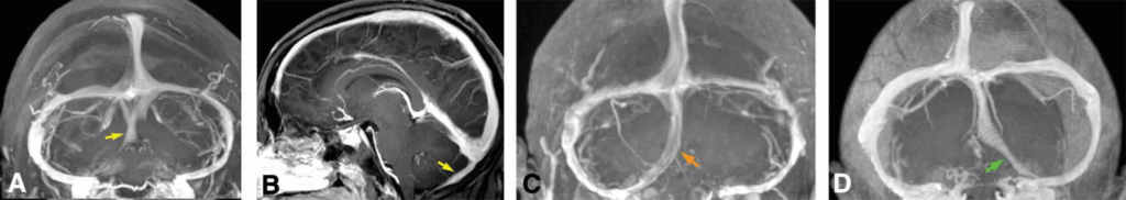 occipital sinus