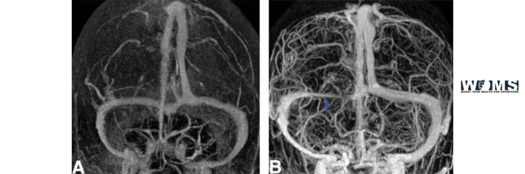 sigmoid sinus