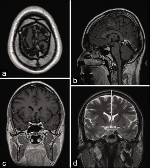 superior sagittal sinus location