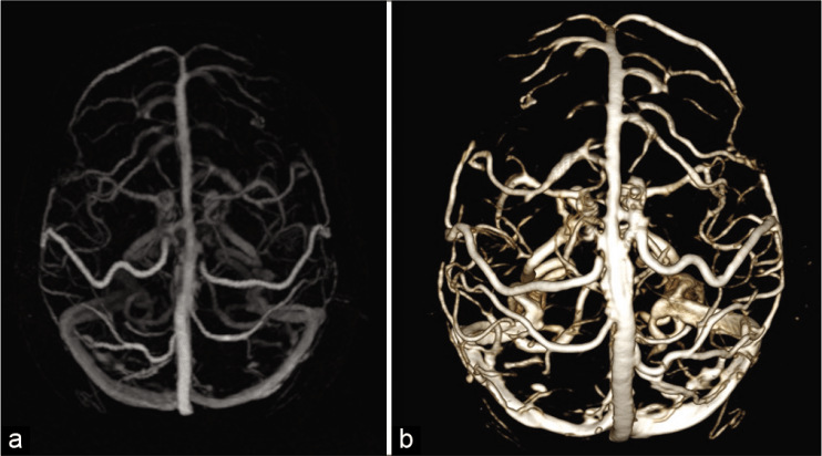 superior sagittal sinus mri