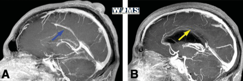 superior sagittal sinus (sss)